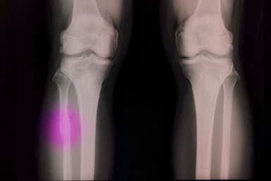 Súng bắn keo nhiệt điều chỉnh sửa chữa xương nhanh chóng chi phí thấp