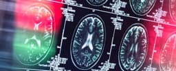 Chuyên gia tiết lộ Alzheimer có thể không phải là bệnh não bộ thuần túy