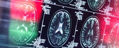 Chuyên gia tiết lộ Alzheimer có thể không phải là bệnh não bộ thuần túy