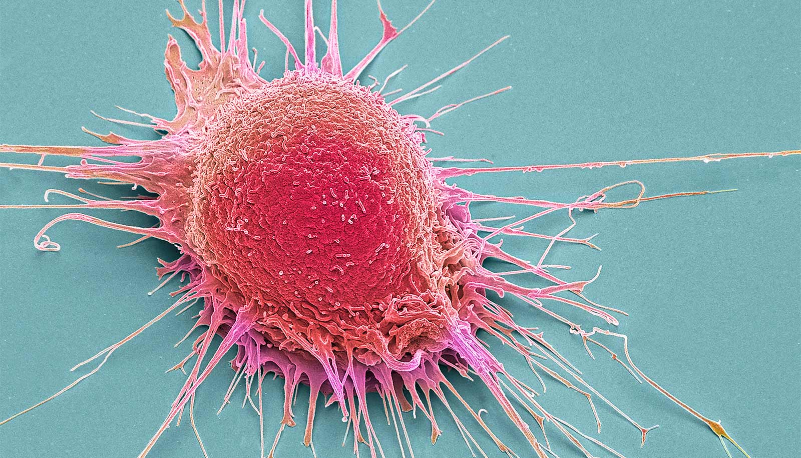 Prostate Cancer Macrophages and Immune Cells