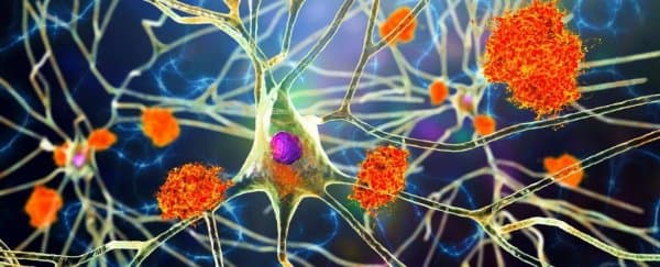 Mảng amyloid trong bệnh Alzheimer